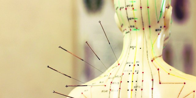 Ambulante Zusatzversicherungen decken auch Akupunkturbehandlungen ab. Der gezielte Einsatz von Nadeln hilft Patienten u. a. bei Kopfschmerzen und Rheuma. (Bild iStock)