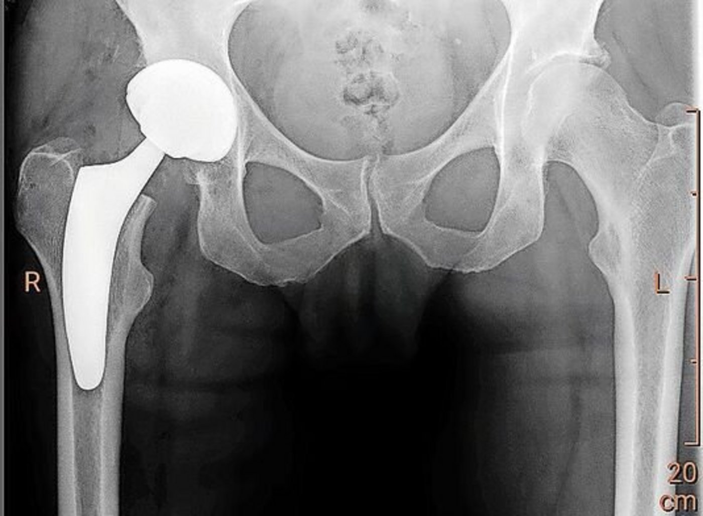 Manchmal ist es unausweichlich, das Hüftgelenk zu ersetzen.